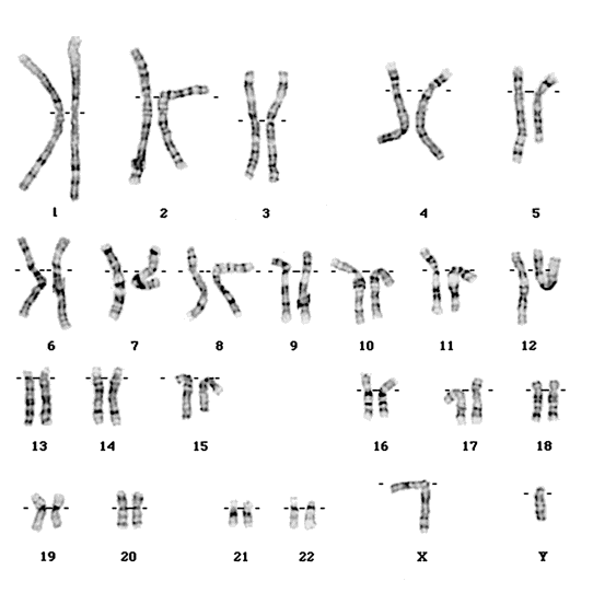 cariotipo translocacin 5;8)